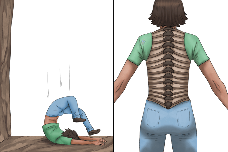 I fell off the vertical cliff and needed a brace (vertebrae) for each of the small bones forming my backbone.